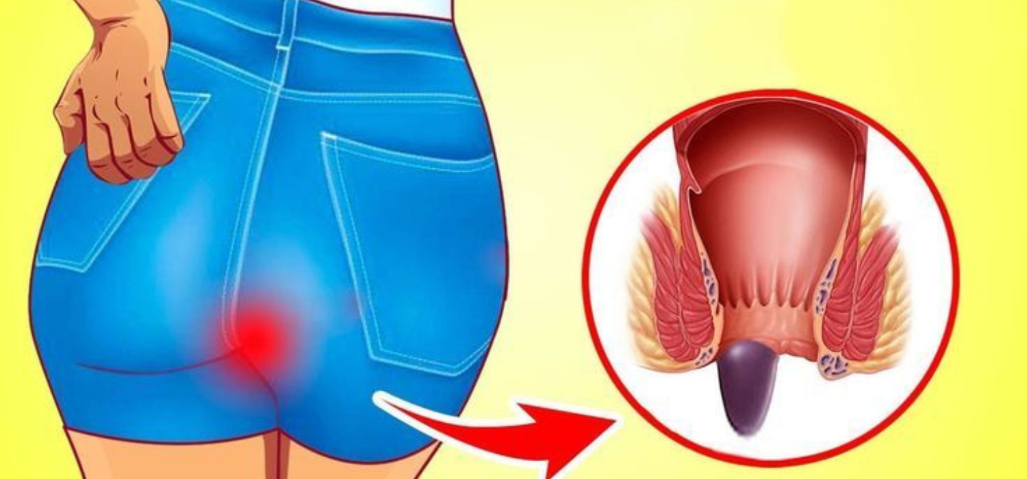 What Are The Best Ayurvedic Treatments For Piles